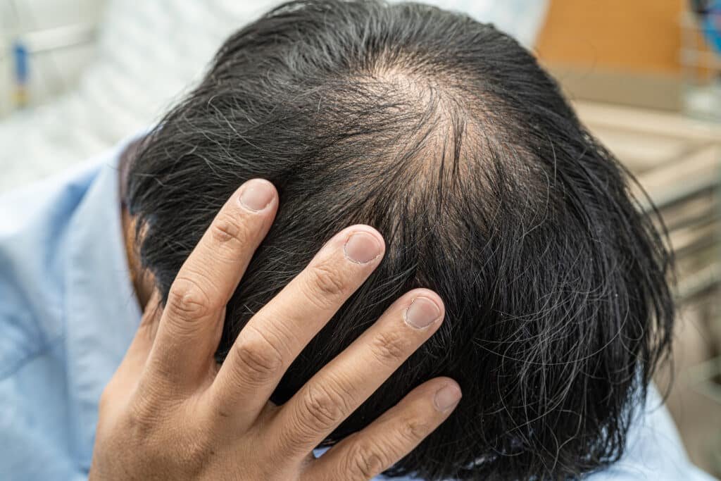 Men often face the challenge of male pattern baldness, where hairlines recede or thinning occurs on the crown. Genetics and hormones play a key role here.