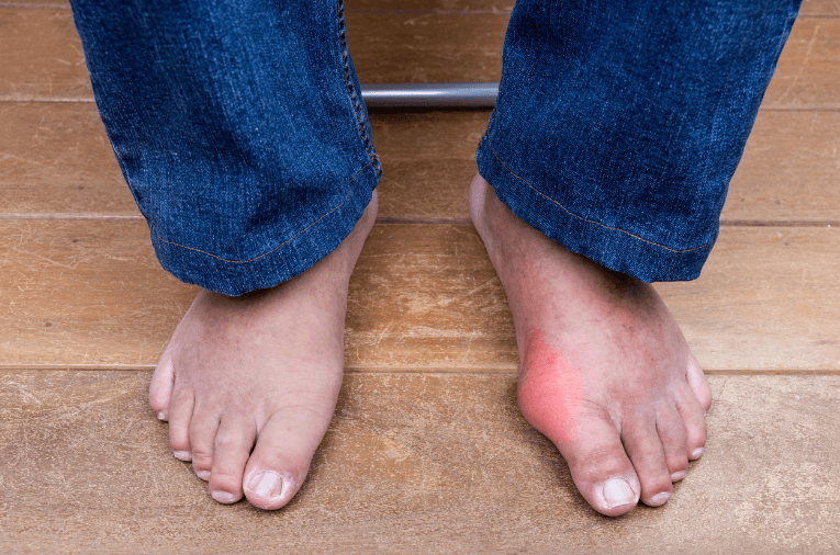 There are many types of arthritis. Gout is one of the most common types of this disease.