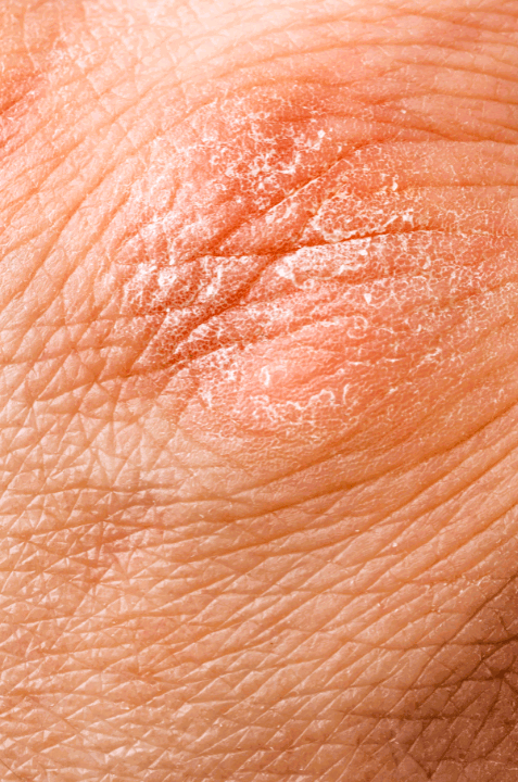 Homeopathy for eczema heals the cause with tailored remedies for long-term skin relaxation and equilibrium.