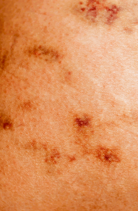 Eczema, also known as atopic dermatitis, is a recurring skin condition that causes the skin to dry out, itch, and become inflamed and irritated.