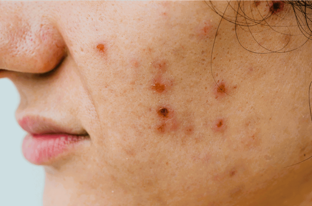 The best homeopathic remedies can offer long-lasting comfort and help your skin regain its equilibrium, whether you're dealing with sporadic pimples or chronic cystic acne.