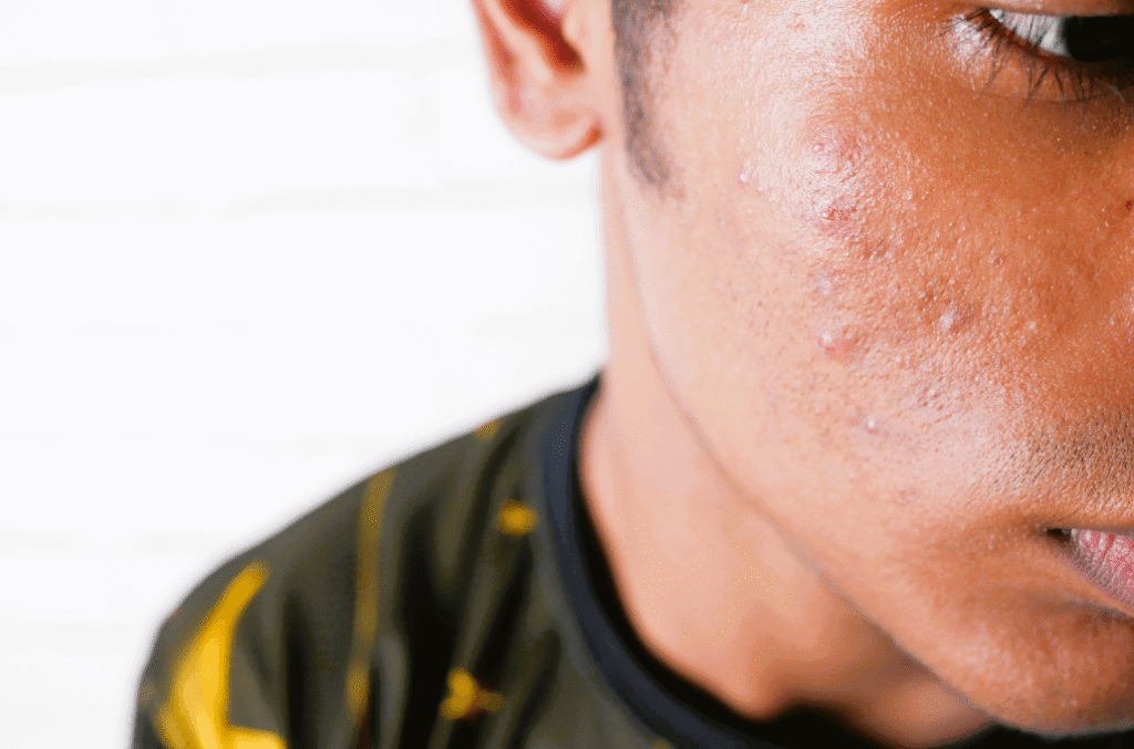 Stress and anxiety can be causes for acne.