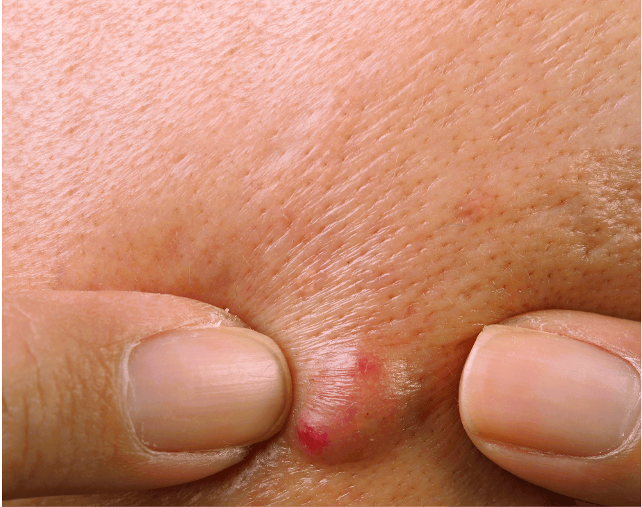 The best homeopathic remedies can  treat Acne with big, angry pustules that hurt when you touch them.
 